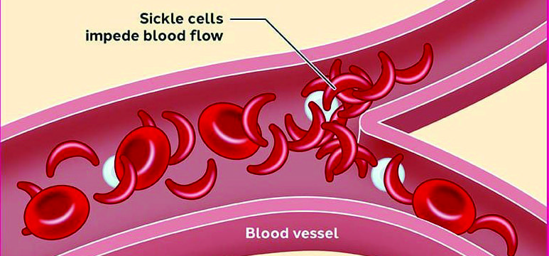 Normal vs Sickle Cell Diagram
